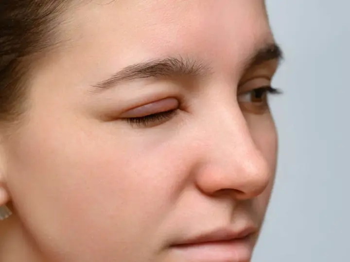 Occhi rossi e gonfi, forse per una reazione allergica. La palpebra è visibilmente gonfia e irritata.