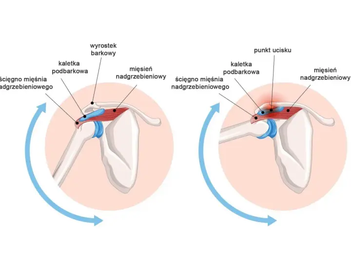 Ilustracja pokazuje palpacja wyrostka kruczego łopatki, z zaznaczonym punktem ucisku na ścięgnie mięśnia nadgrzebieniowego.