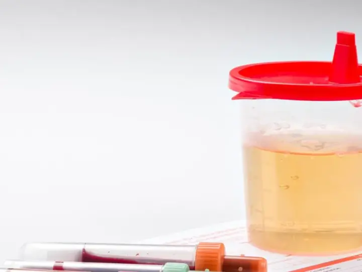 Pojemnik z żółtym płynem i próbówki z krwią. Wyniki badań wskazują na erytrocyty w moczu.