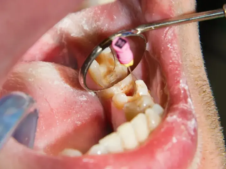 Zgorzel zęba to martwica miazgi. Widoczny ząb w lustrze dentystycznym, z narzędziem w kanale korzeniowym.