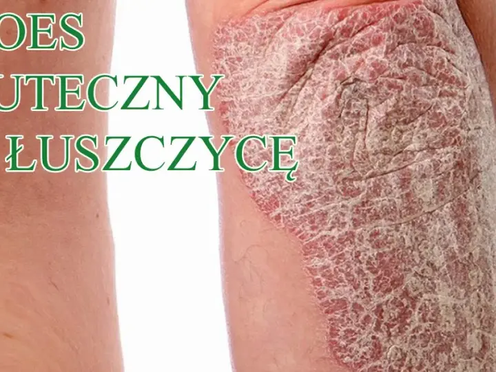 Czy jest nowy lek na łuszczycę? Odkryj najnowsze terapie i ich skuteczność