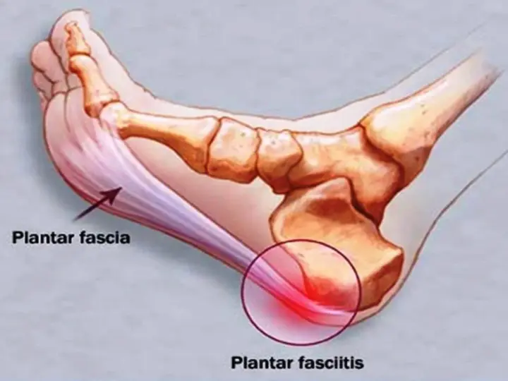 Illustration av fotens anatomi som visar plantar fascia och smärta vid plantar fasciitis.