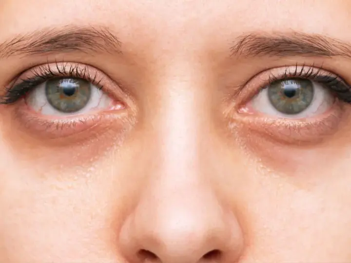 Primer plano de unos ojos con ojeras marcadas. Consejos para como quitar ojeras y lucir una mirada más descansada.