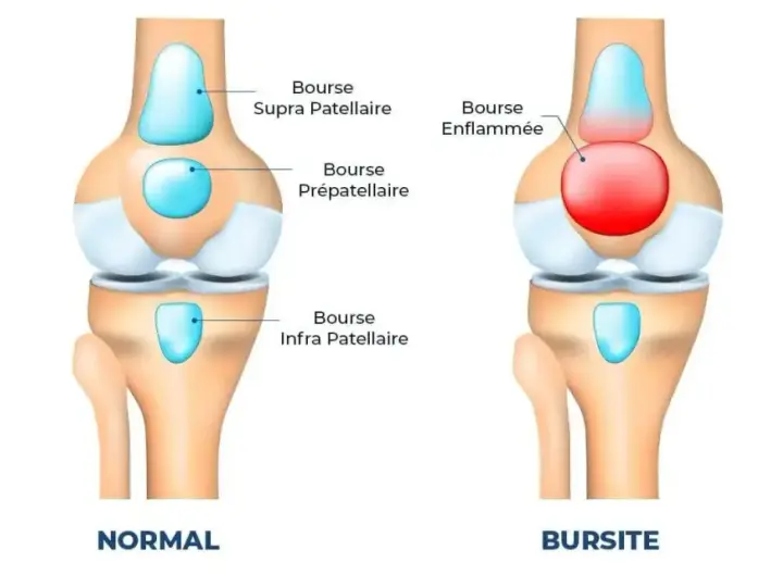 Comparaison d'un genou normal et d'un genou atteint de bursite. La bourse prépatellaire est enflammée et gonflée, causant un genou gonflé.