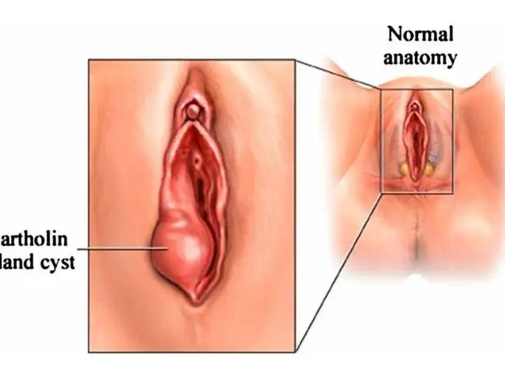 Powiększony gruczoł Bartholina po lewej, obok schematu prawidłowej anatomii.