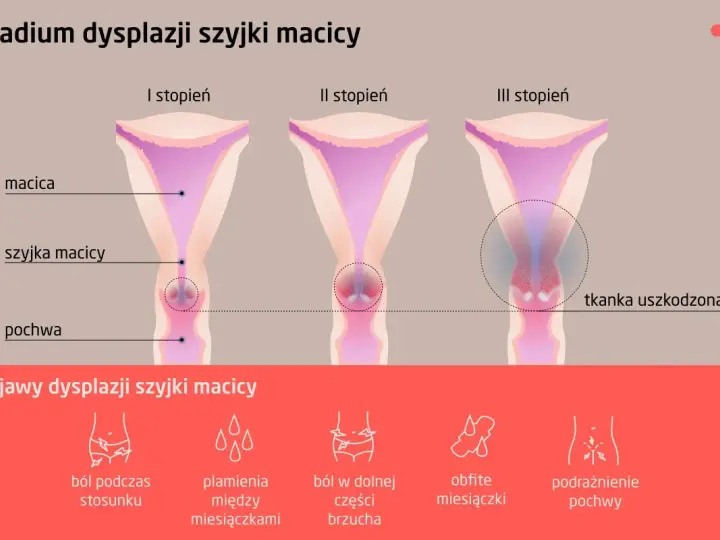 Ilustracja przedstawia trzy stadia dysplazji szyjki macicy: I, II i III stopień, z zaznaczonymi objawami.