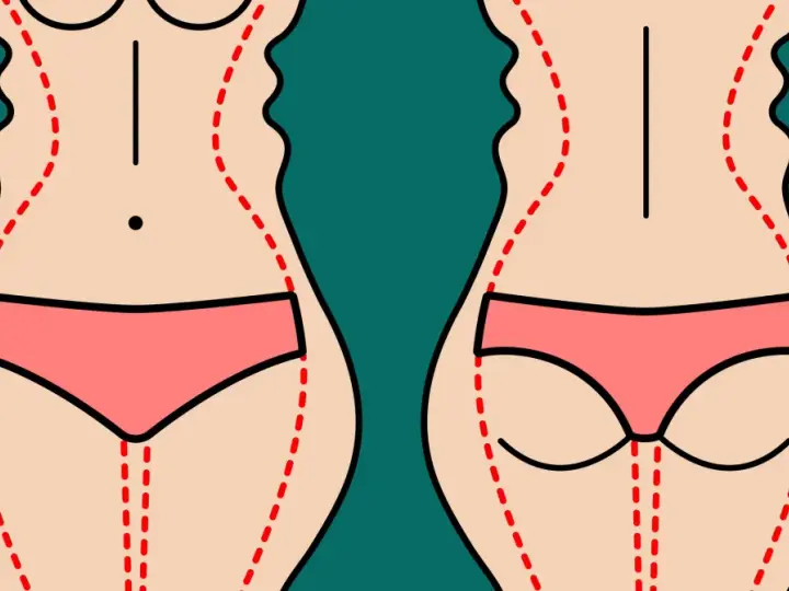 Ilustracja pokazuje sylwetki z zaznaczonymi liniami, sugerującymi zabieg. Warto znać liposukcja kawitacyjna przeciwwskazania.
