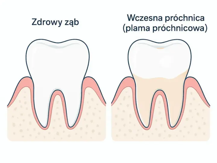 Zdrowy ząb obok zęba z wczesną próchnicą, czyli plamą próchnicową. Dentysta widzi różnicę w kolorze i strukturze szkliwa.