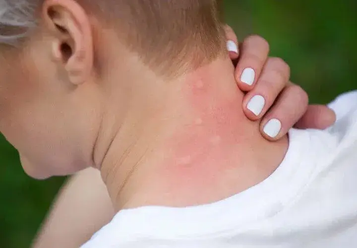 Jak wygląda alergia pokarmowa? Objawy, przyczyny i skuteczne leczenie