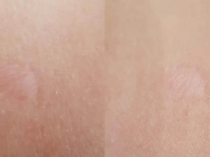 Jasna skóra z widocznymi, lekko zaróżowionymi bliznami po depilacji laserowej.