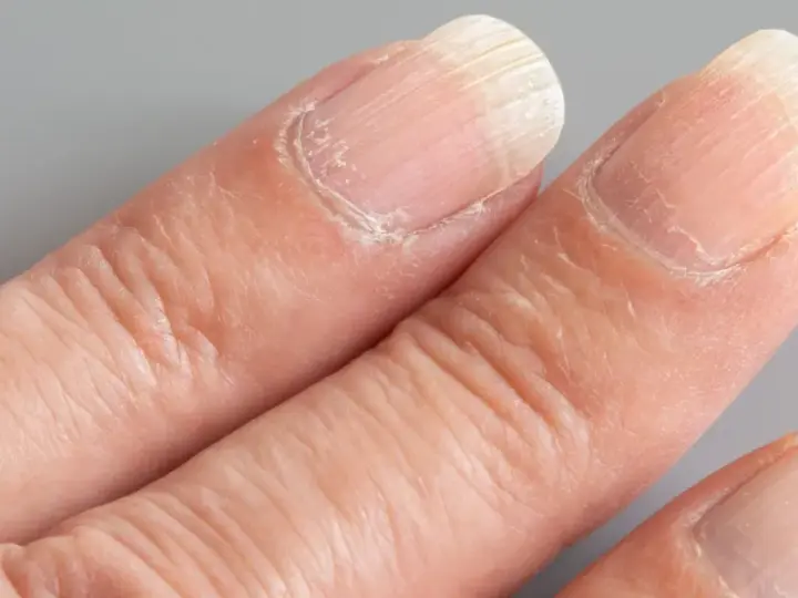 Gros plan sur des doigts montrant des ongles striés verticalement. La signification de ces ongles striés peut varier.