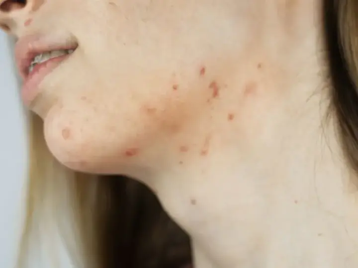 Widoczny trądzik na żuchwie i szyi. Czerwone krostki i przebarwienia na skórze.