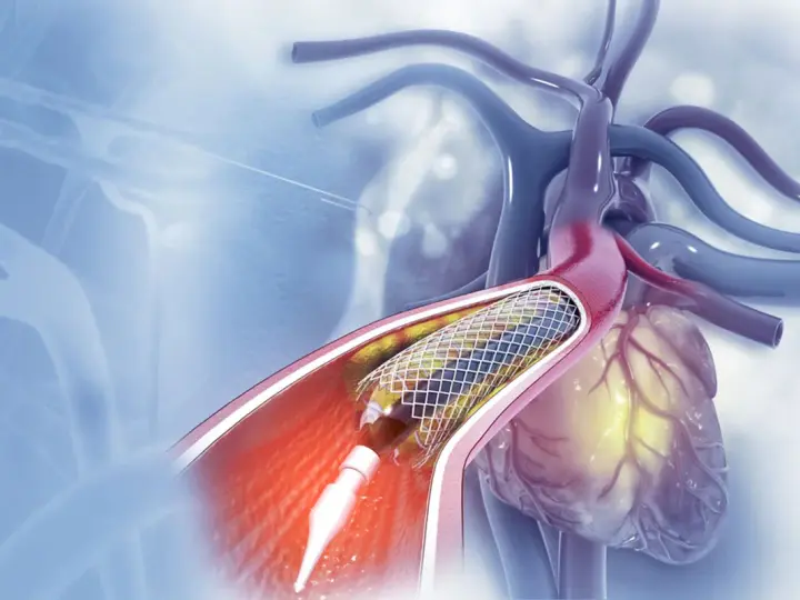 Stent w tętnicy serca podczas zabiegu angioplastyki.
