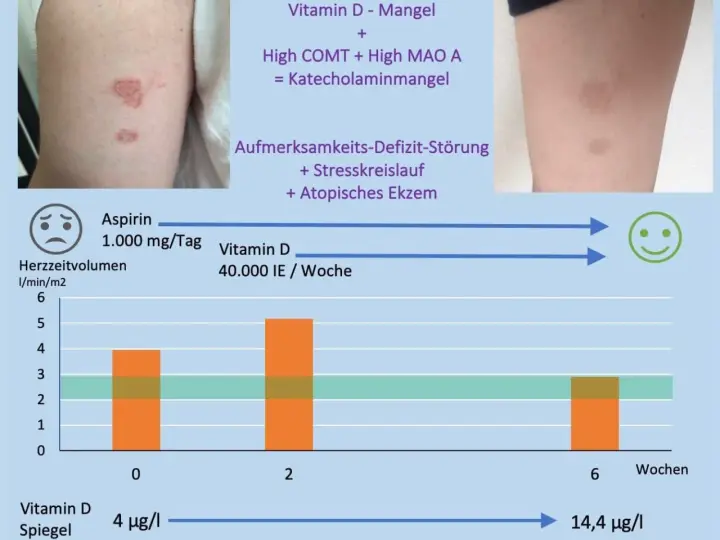 Vitamin D Mangel Symptome bei Erwachsenen: Erfahrungsberichte und Anzeichen