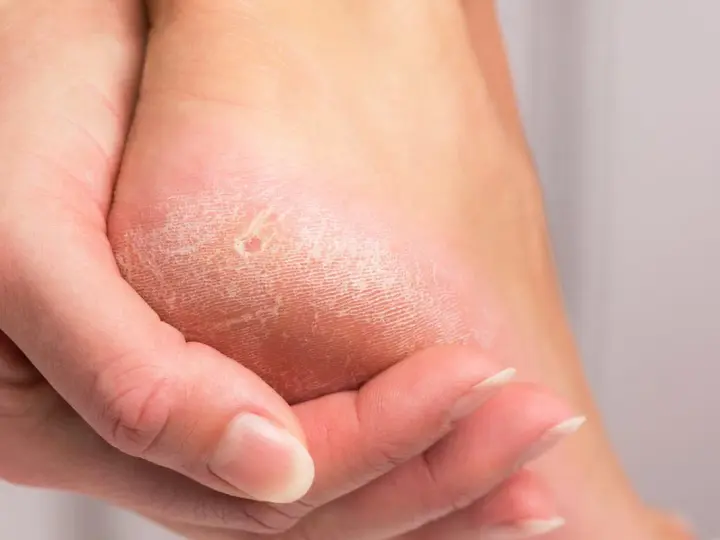 Gros plan sur un talon sec et craquelé, montrant des crevasses. Une main touche la peau pour illustrer comment soigner les crevasses.