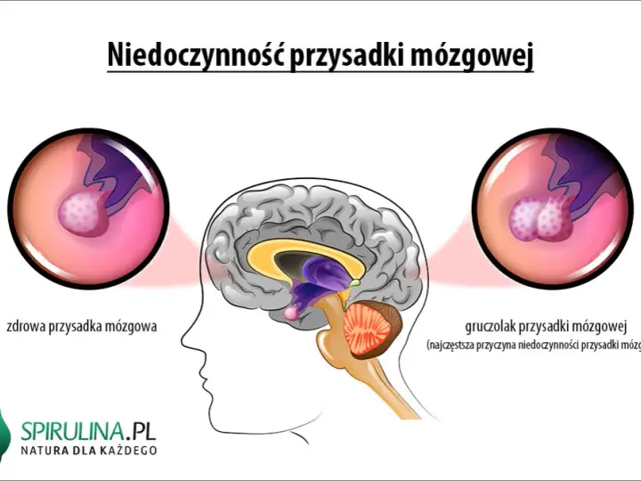 Mgła mózgowa, lęk, depresja? To może być gruczolak przysadki