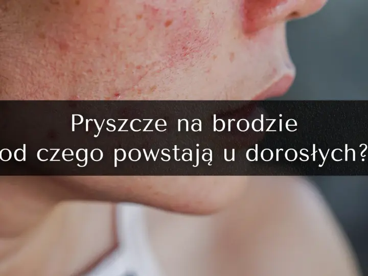 Pryszcze na brodzie: Jak się ich pozbyć? Kompletny poradnik ekspertki