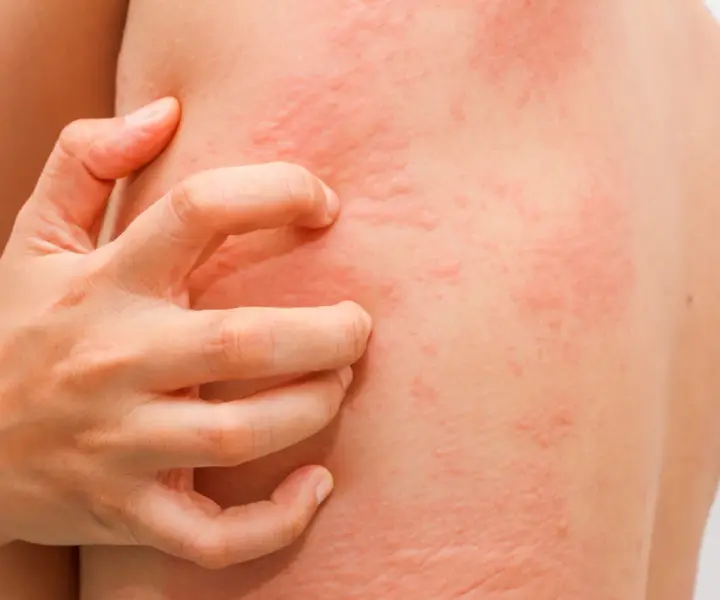 Uczulenie na salicylany: bezpieczne leki przeciwbólowe, które działają