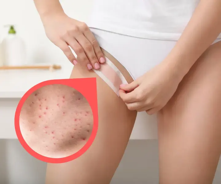 Jak pozbyć się krost po goleniu bikini i uniknąć podrażnień