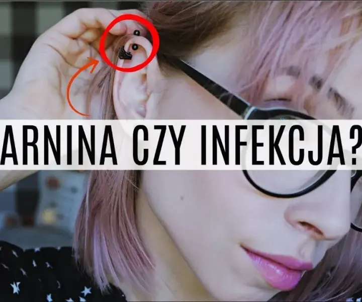 Jak skutecznie leczyć ziarninę po piercingu i uniknąć powikłań