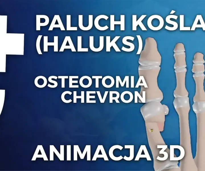 Gdzie operować haluksy na NFZ? Sprawdź dostępne placówki i terminy