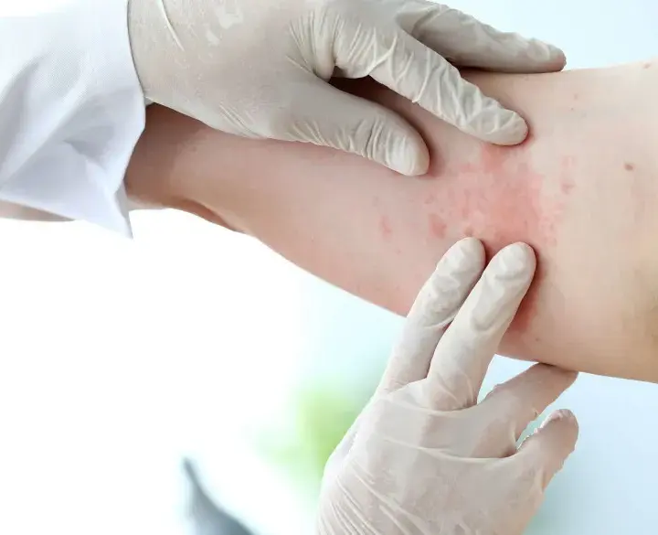 Alergia na chemikalia objawy: poznaj niebezpieczne reakcje i objawy