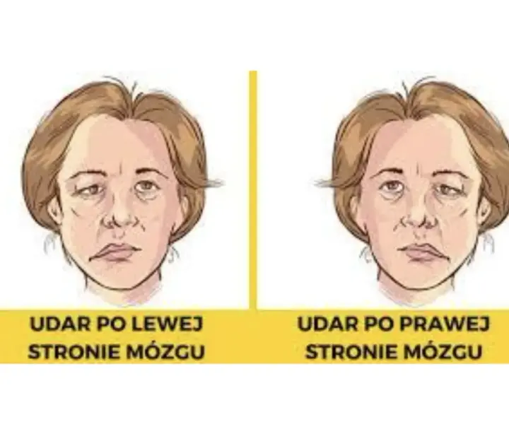 Który udar jest groźniejszy: prawostronny czy lewostronny? Porównanie skutków i rokowania