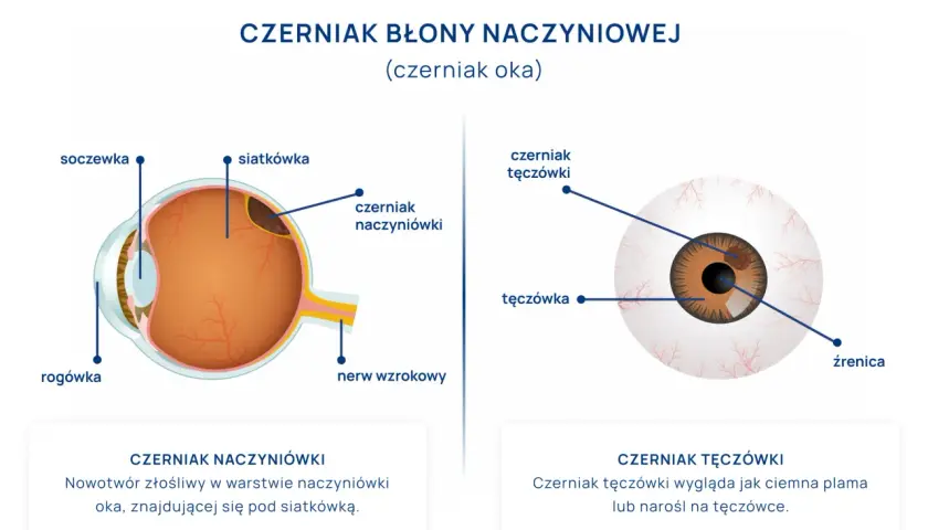 Schemat oka z zaznaczonym czerniakiem naczyniówki i czerniakiem tęczówki.