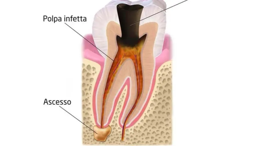 Sezione di un dente con carie e polpa infetta. Alla base della radice si nota un ascesso, segno di infezione.