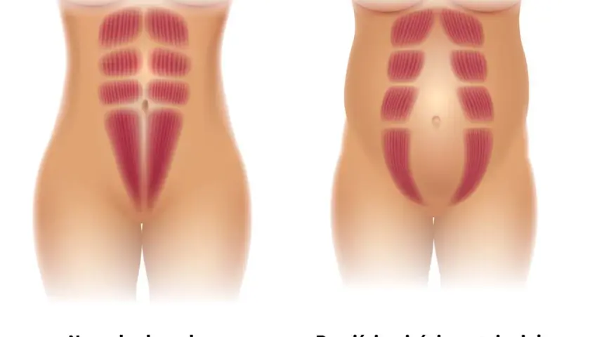 Ilustracja porównuje normalny brzuch z rozejściem mięśni brzucha w czasie ciąży, pokazując rozdzielenie mięśni prostych brzucha.