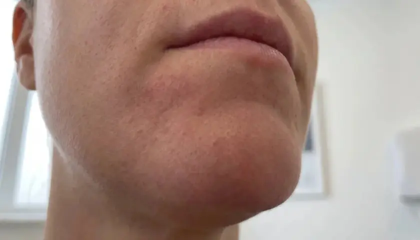När perioral dermatit stressar huden runt munnen syns rodnad och små utslag.