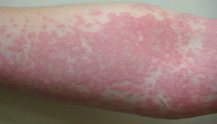 Brazo con erupción cutánea de ronchas rosadas y elevadas, algunas pequeñas y dispersas, otras formando parches más grandes.