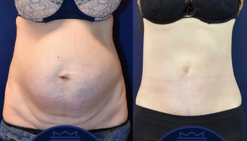 Före- och efterbilder visar tydliga fettsugning resultat på magen. Huden är slätare och midjan smalare.