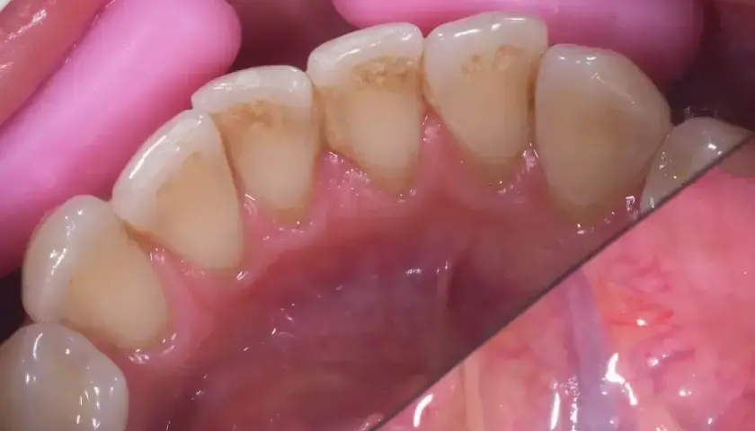 Widoczne przebarwienia na zębach, szczególnie wzdłuż linii dziąseł. Różowe separatory utrzymują usta otwarte.