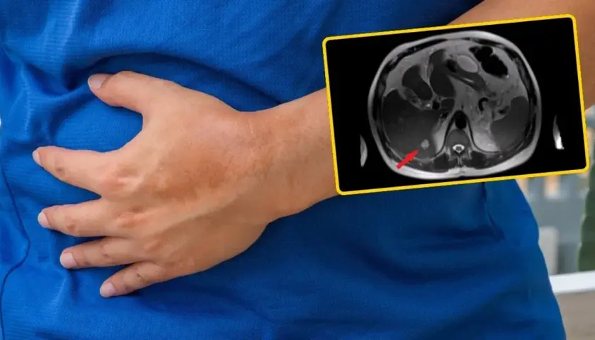 Osoba trzymająca się za brzuch, obok obraz rezonansu magnetycznego wątroby ze strzałką wskazującą zmianę.