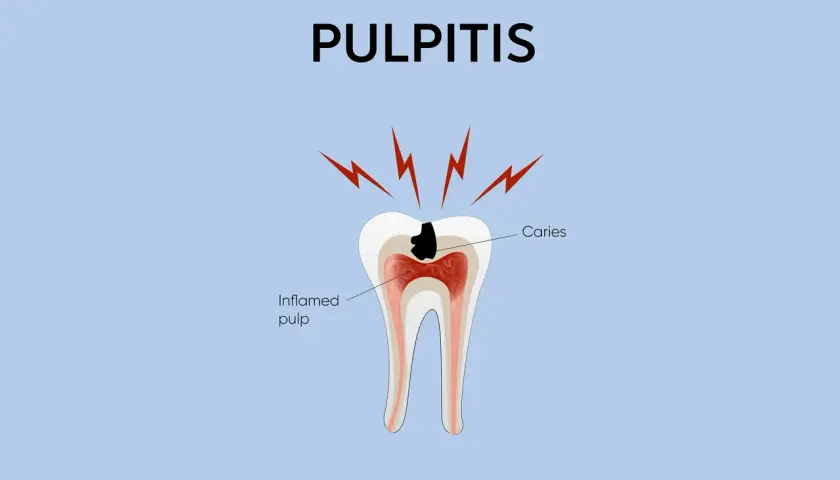 Illustrazione di un dente con carie che causa infiammazione del nervo del dente (polpa).