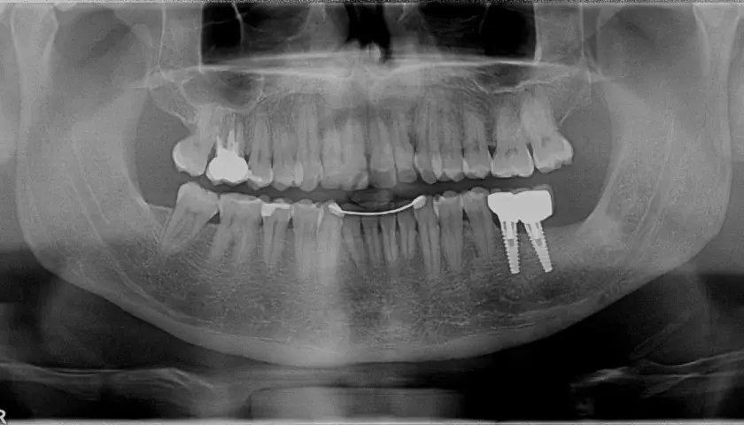Radiografia panoramica dentale mostra impianti dentali e una protesi. Si nota una sacca gengivale in corrispondenza di un dente.