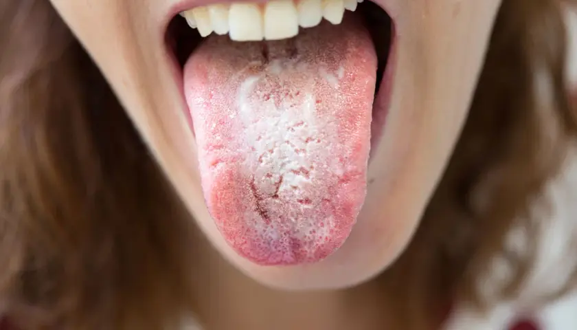 Lingua con placche biancastre, segno di candida in bocca.