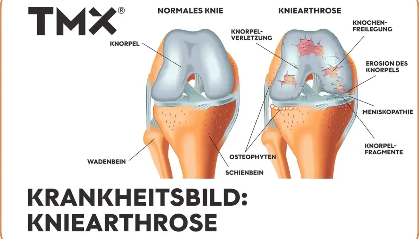 Vergleich von gesundem Knie und Kniearthrose. Die Darstellung zeigt Knorpelverschleiß, Erosionen und Knochenreizungen – eine mögliche "wunderwaffe gegen arthrose knie" könnte hier Abhilfe schaffen.