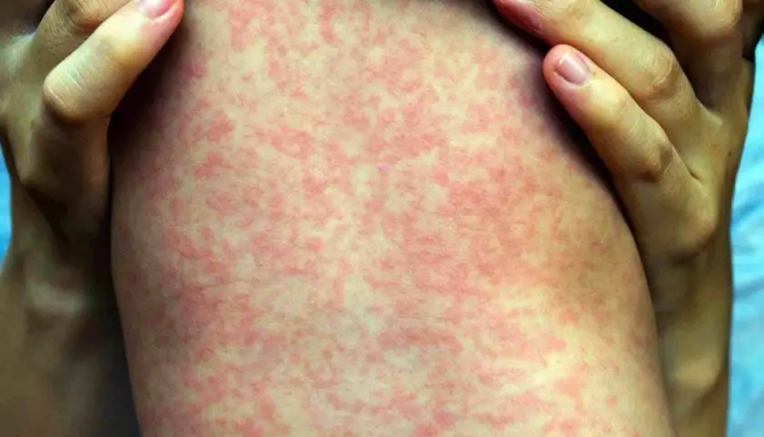 Macchie rosse sulla pelle bambini, un'eruzione cutanea diffusa che potrebbe richiedere attenzione medica.