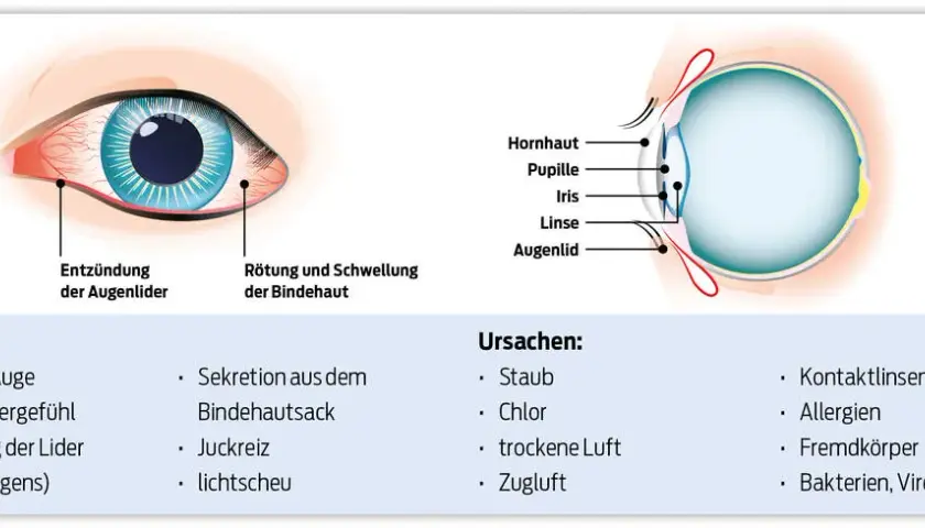Wirksame Medikamente gegen Bindehautentzündung: Tipps und Empfehlungen