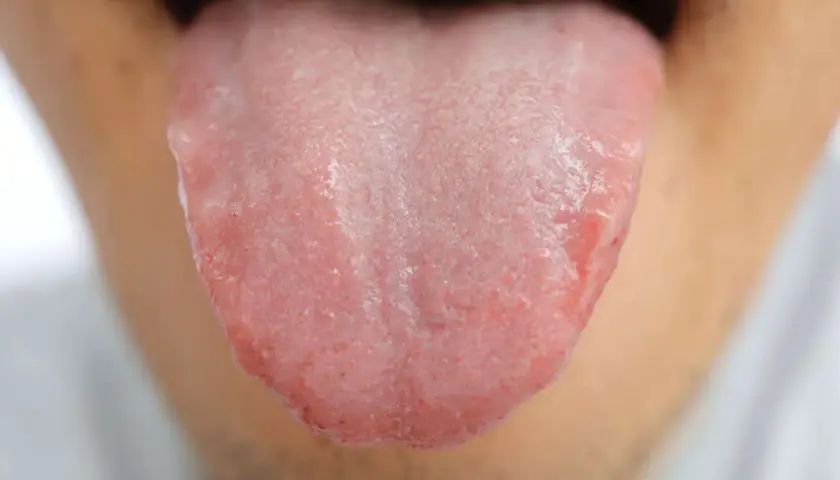 Lingua arrossata e irritata, con papille evidenti, che suggerisce un bruciore alla lingua.