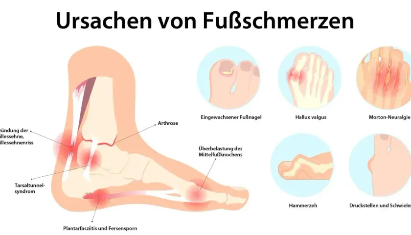 Illustration zeigt Ursachen von Fußschmerzen: Achillessehnenentzündung, Hallux valgus, Morton-Neuralgie, Hammerzeh, Fersensporn und mehr.