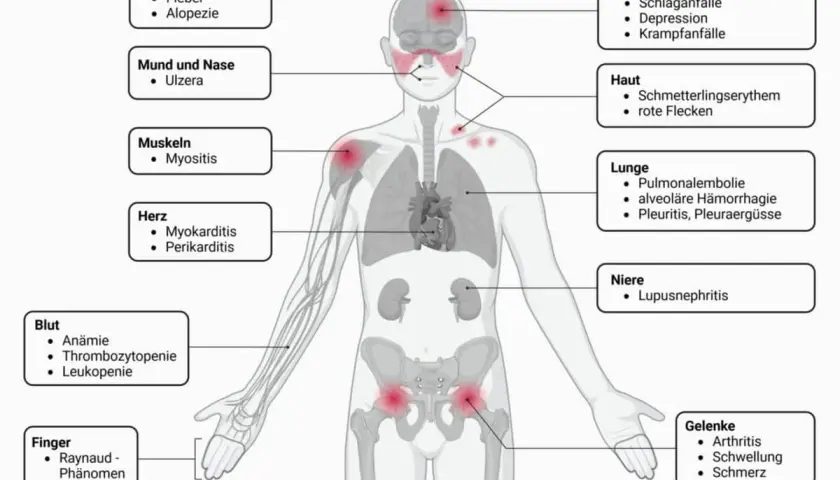 Lupus Symptome: Erkennen Sie die alarmierenden Anzeichen rechtzeitig