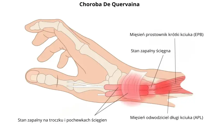 Anatomia dłoni z zaznaczonym stanem zapalnym ścięgien kciuka, wskazującym na chorobę De Quervaina. Pomocne przy ćwiczeniach na nadgarstek.