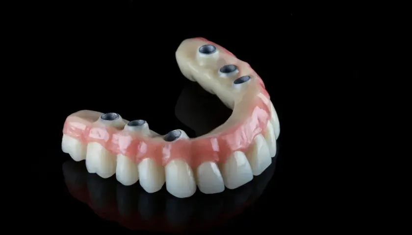 Protesi dentale mobile senza palato, con attacchi metallici per un sorriso fisso e naturale.