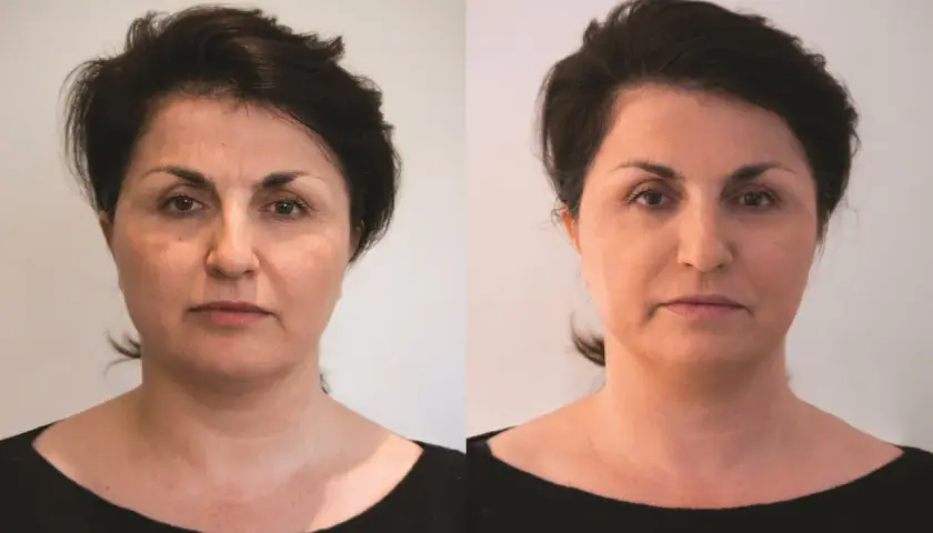 Porównanie twarzy kobiety przed i po zabiegu, ukazujące zmiany w wyglądzie.