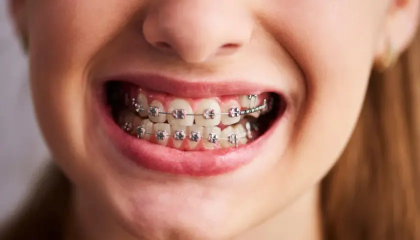Uśmiechnięta twarz z aparatem ortodontycznym. Krótka wizyta u dentysty, a potem już tylko czekanie na efekt. Ile trwa zakładanie aparatu?