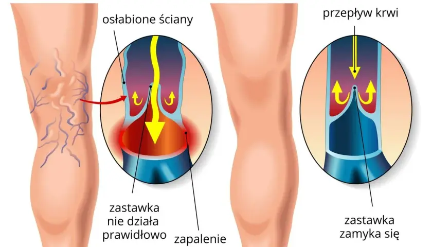 Porównanie żylaków i zdrowych żył. W żylakach zastawka nie działa, powodując zastój krwi. W zdrowych żyłach zastawka zamyka się prawidłowo.