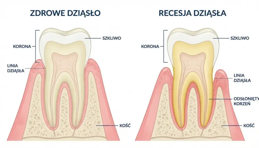 Zdrowe dziąsło vs recesja dziąsła. Ilustracja pokazuje, co to jest kiretaż, porównując zdrowe dziąsło z cofniętym, odsłaniającym korzeń.